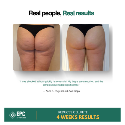 Efpercess™ RevivePro 12-Level Cupping & Cellulite Massager